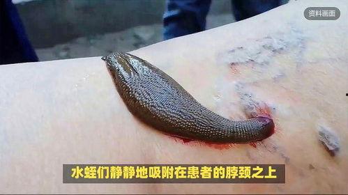 水蛭吸血视频,古老疗法的现代视角