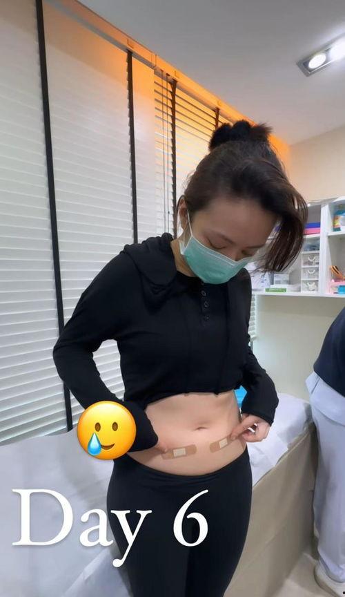 打肚皮针视频,传统中医养生新体验