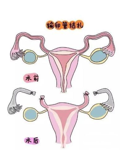 女性结扎视频,安全与健康的守护之旅