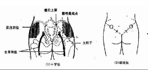 肌内注射视频,肌内注射操作步骤详解与视频教程