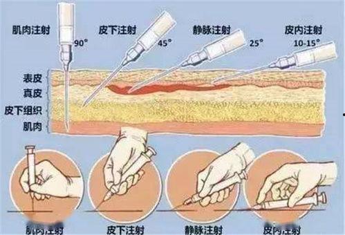 肌内注射视频,肌内注射操作步骤详解与视频教程