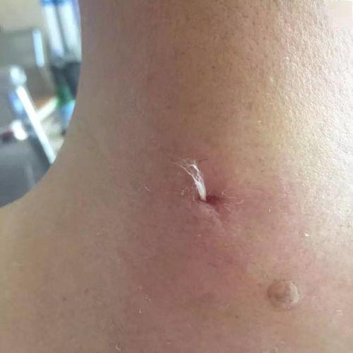 羊毛疔视频,揭秘传统中医治疗羊毛疔的独特方法