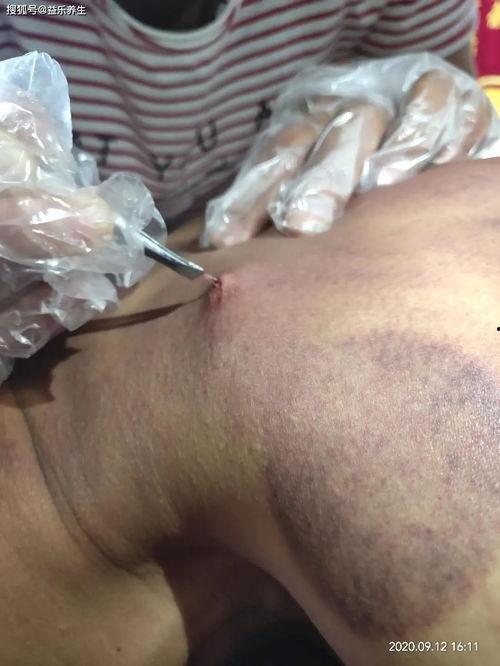 羊毛疔视频,揭秘传统中医治疗羊毛疔的独特方法