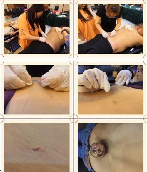 羊毛疔视频,揭秘传统中医治疗羊毛疔的独特方法