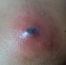 火疖子视频,揭秘民间偏方治疗火疖子的神奇疗效