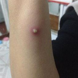 火疖子视频,揭秘民间偏方治疗火疖子的神奇疗效